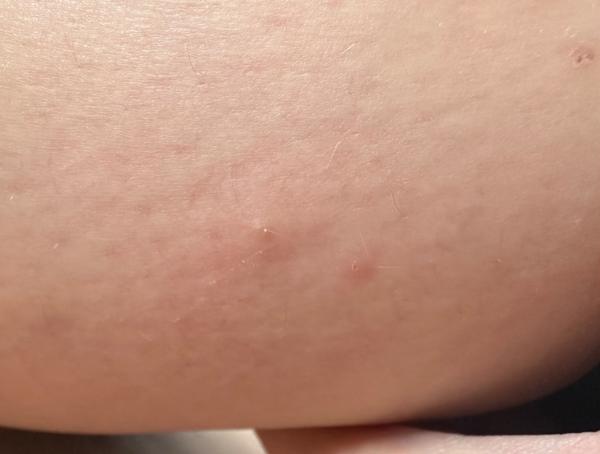 Svědivé puchýřky na těle. Je to svrab nebo alergie?