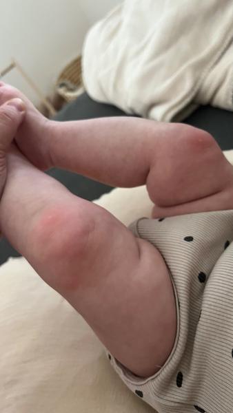 Červené fleky s bílým vnitřkem. Nemůže to mít souvislost s komplikacemi po porodu?