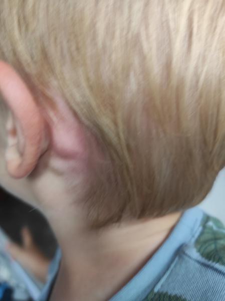 Může být boulička za uchem reakcí na MMR očkování?