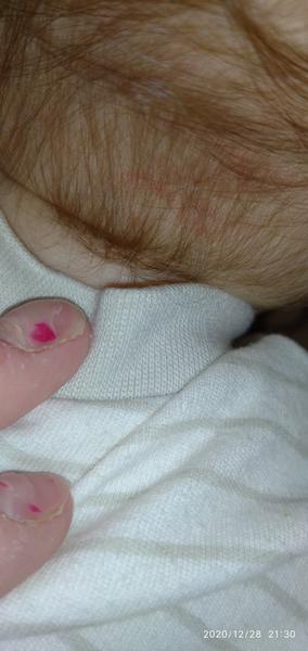 Neštovice. Mohly by to být?