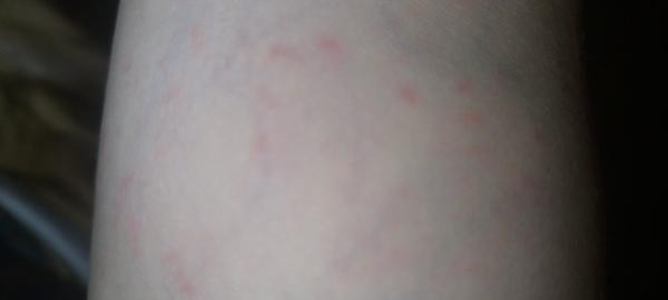 Co způsobuje vyrážku a jaké léky nepomáhají?