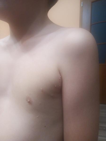 Co může způsobit nateklé puchýřky na těle dítěte?