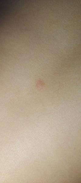 Pupínky na zádech u dítěte: Co to může znamenat?