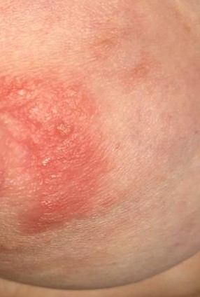 Co to mám kolem bradavky?