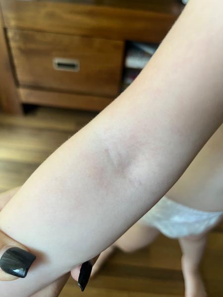 Červené fleky a horečka u dítěte. Co to znamená?