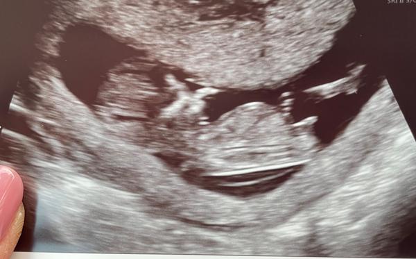 Jak poznat pohlaví z ultrazvuku ve 12. týdnu?