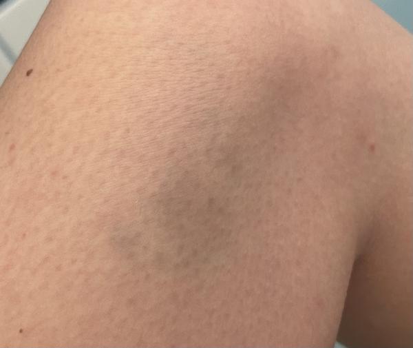 Může být příznakem trombózy modřina?