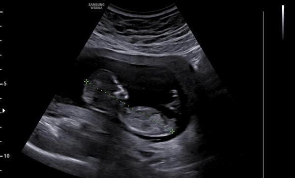 Je možné určit pohlaví na ultrazvuku v prvním trimestru?