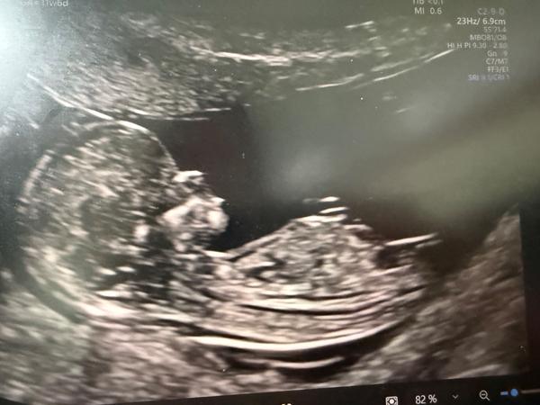 Pohlaví podle screeningu ve 12. týdnu. Co myslíte?