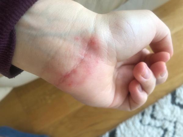 Atopický ekzém v těhu. Dieta?