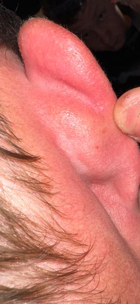 Vyrážka. Co to může být a jak to léčit?