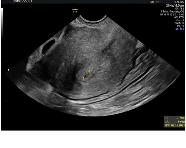 Čtení na ultrazvuku. Co mohu vidět?