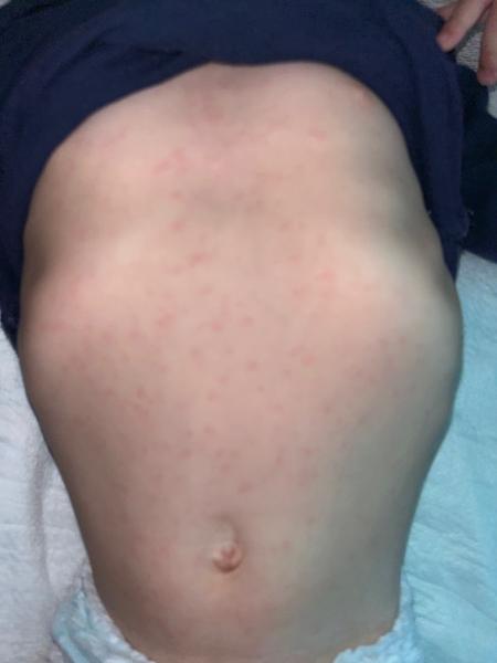 Vyrážka po střevní viróze u batolete. Máte zkušenost?