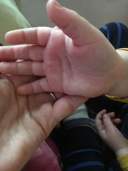 Ekzém u 3 letého dítěte. Hodně se škrábe a kortikoidy nepomáhají. Co více zkusit?