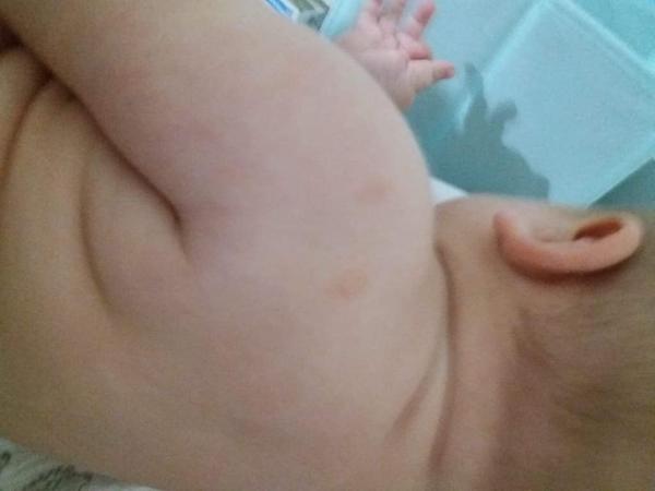 Ekzém. Co by pomohlo?