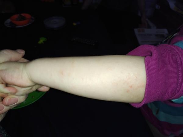 Svědivá vyrážka. Co by to mohlo být?