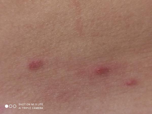 Může se jednat o neštovice bez dalších příznaků?