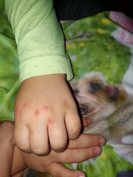 Vyrážka na rukou u syna. Co to může být?