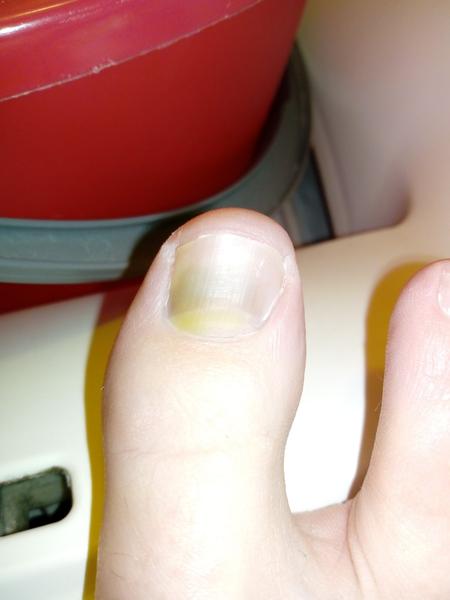 Nazelenalý, nažloutlý nehet na palci. Je to plíseň? Anebo co to může být?