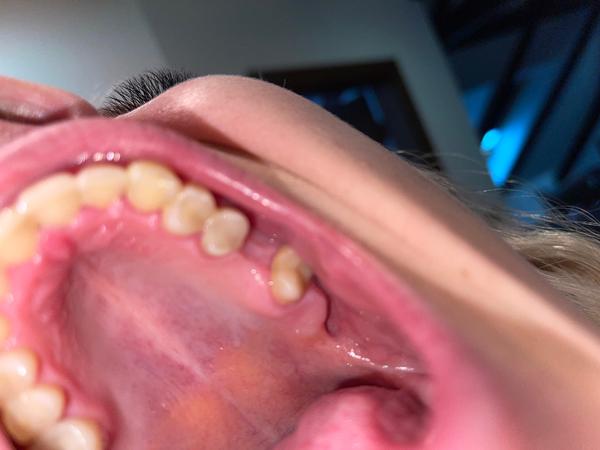 Problémy po vytržení zubu: Je to normální?