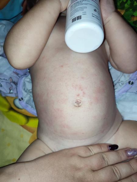 Vyrážka. O co by se mohlo jednat?