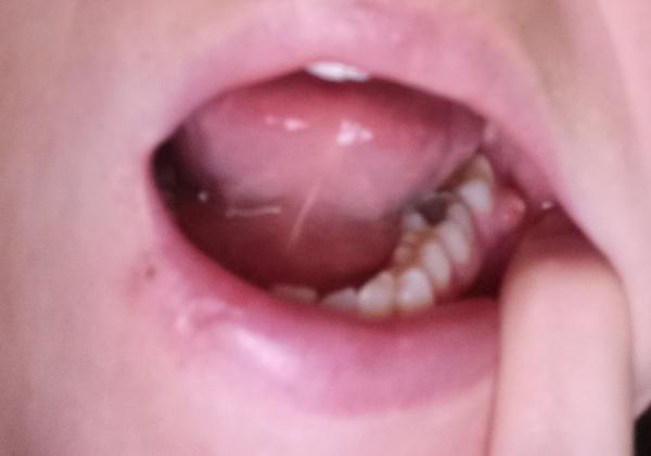 Covid a nateklý zub. Jak postupovat v těhotenství?