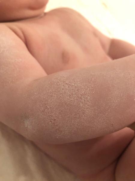 Ekzém nebo kvasinka. Jak a čím pokračovat v léčbě?