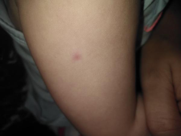 Ekzém nebo neštovice?