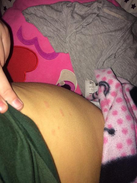 Červené fleky na kůži