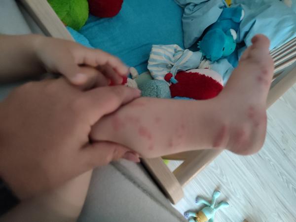 Vyrážka na noze po kontaktu s trávou a jahodami?