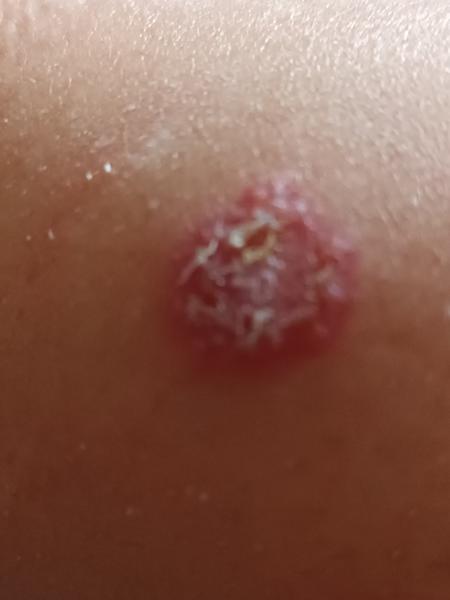 Je to streptokok nebo zlatý stafylokok? Odborná pomoc na fóru.