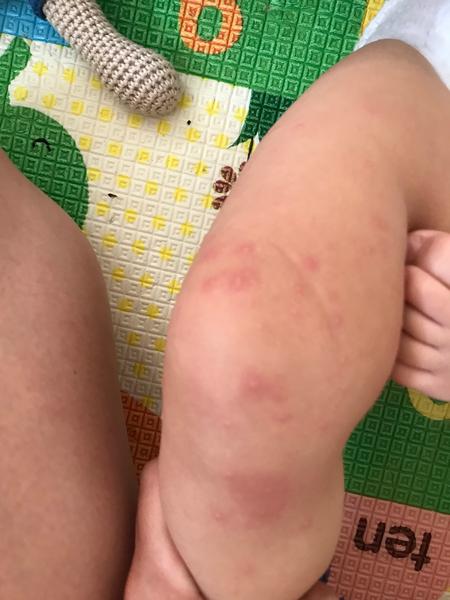 Vyrážka na nozičkách ročního chlapečka. O jakou vyrážku by se mohlo jednat?