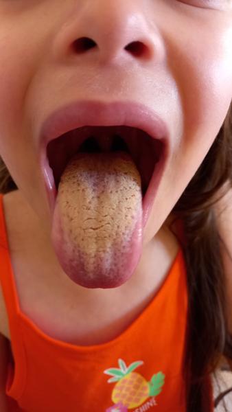 Žluto-bílý povlak na jazyku po vytržení zubů u dcery?