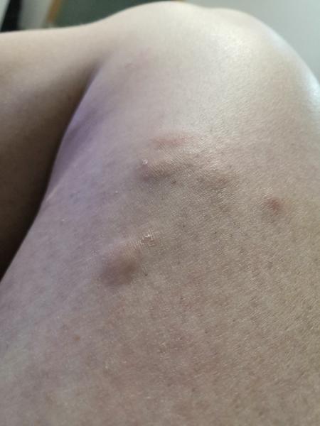 Červené fleky na nohách. O co by se mohlo jednat?