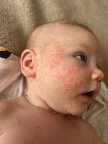 Jak zmírnit novorozenecké akné u šestitýdenního miminka?
