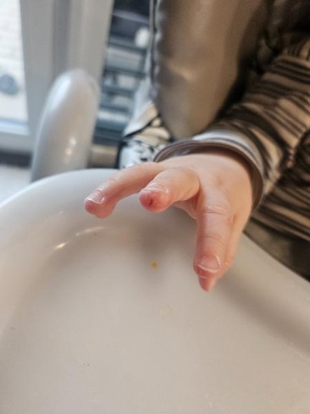 Popraskaná kůže na prstech u batolete. Co pomáhá?