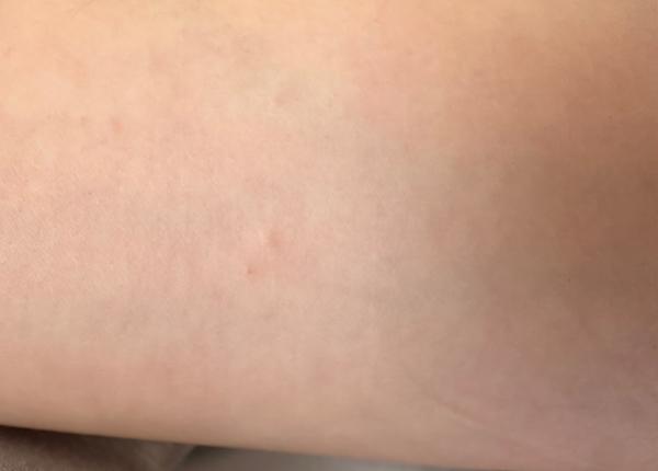 Svědivé puchýřky na těle. Je to svrab nebo alergie?