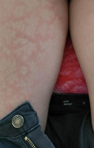 Fleky na stehně u dítěte: Mohla by to být cukrovka?