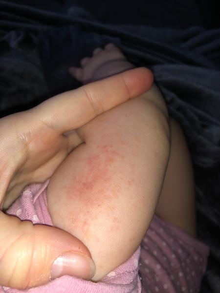 Vyrážka u dítěte. Co by to mohlo být?