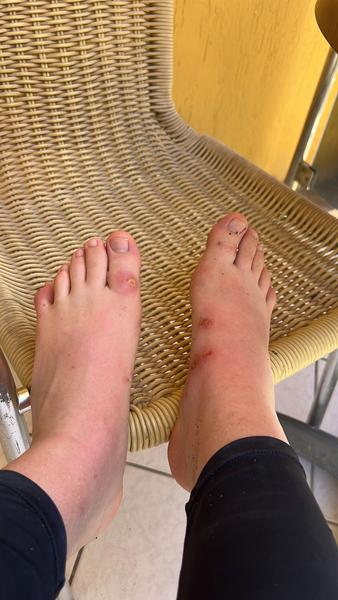 Puchýře a otékání nohou v těhotenství na dovolené v Turecku