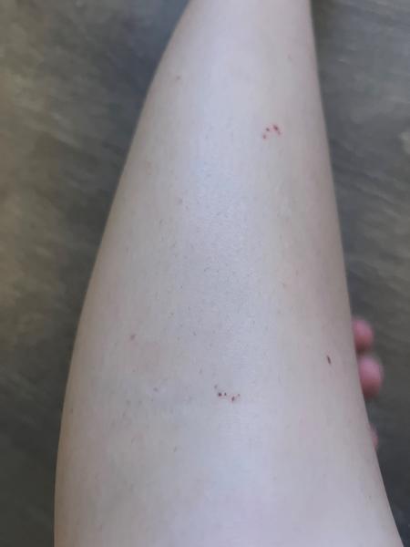 Jak řešit svědění a vyrážku na těle?