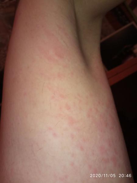 Výrážka na počátku těhotenství. Měly jste? Co pomohlo?