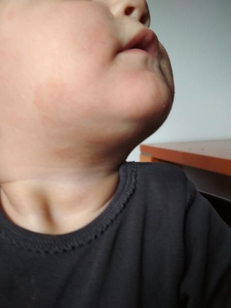 Trvající zarudnutí okolo úst u roční dcery. Prosím, poradíte?