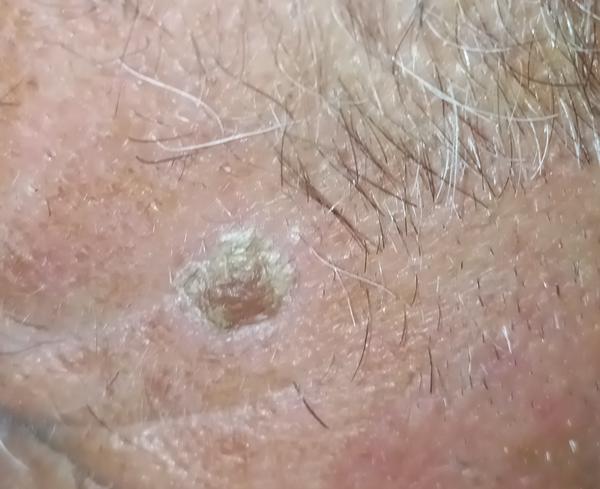 Kožní problém na hřbetu ruky a čele. Co to může být?