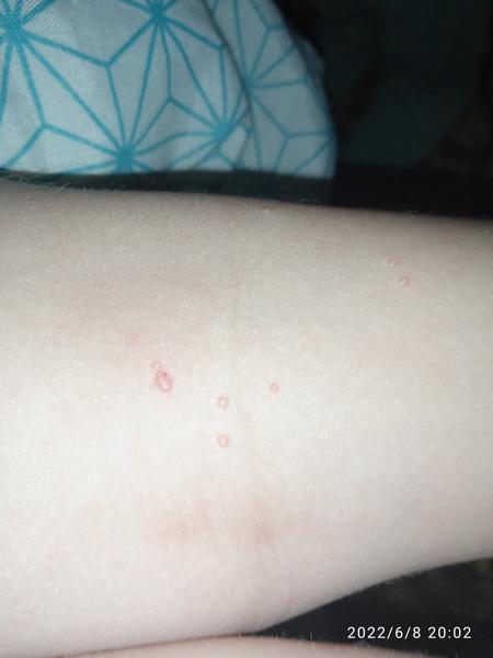 Jsou na nohou dítěte molusky? Jak to poznat?