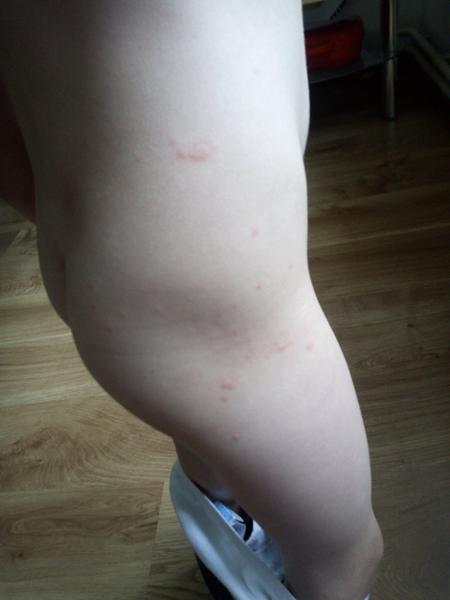 Mohou to být pupínky ze slunce?