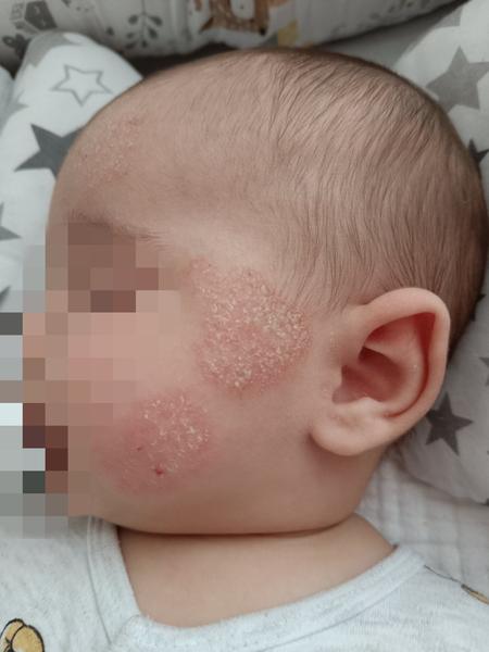 Jak léčit dětský ekzém v obličeji? Rady a tipy