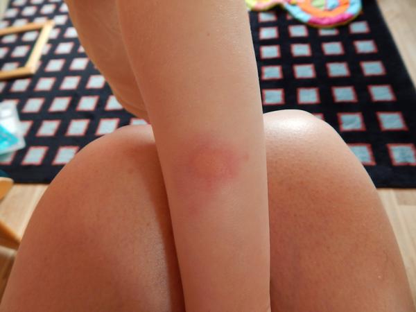 Štípanec nebo kopřivka?