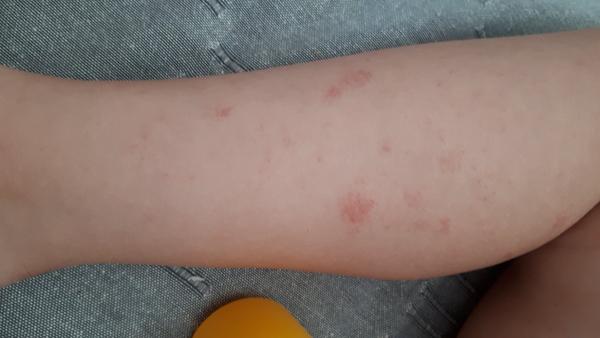 Ekzém (kvasinka) nebo alergie?