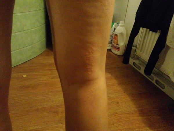 Udělaly se mi nějaké pupínky na nohou a na loktech